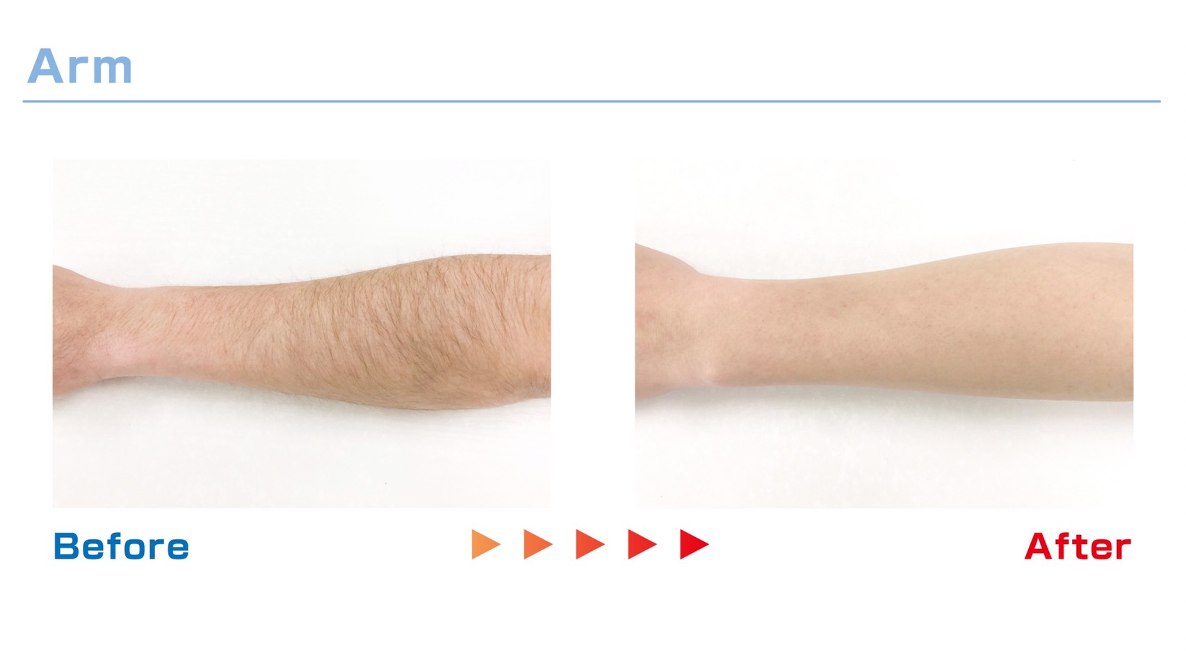 腕の脱毛 Before / After