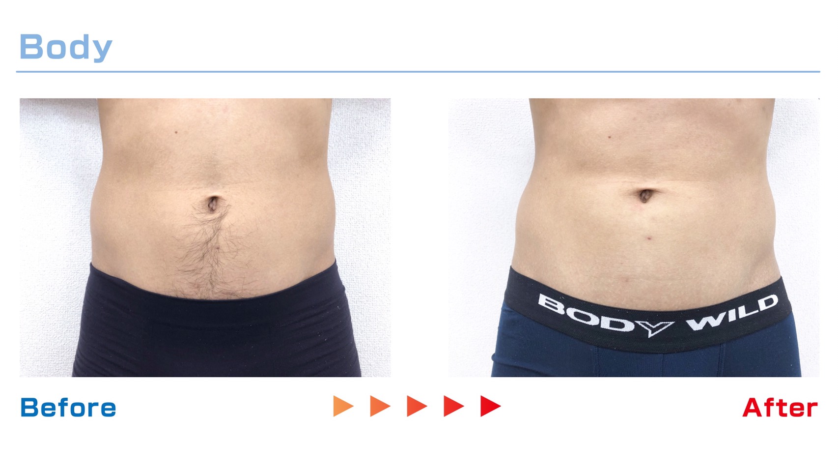 お腹の脱毛 Before / After