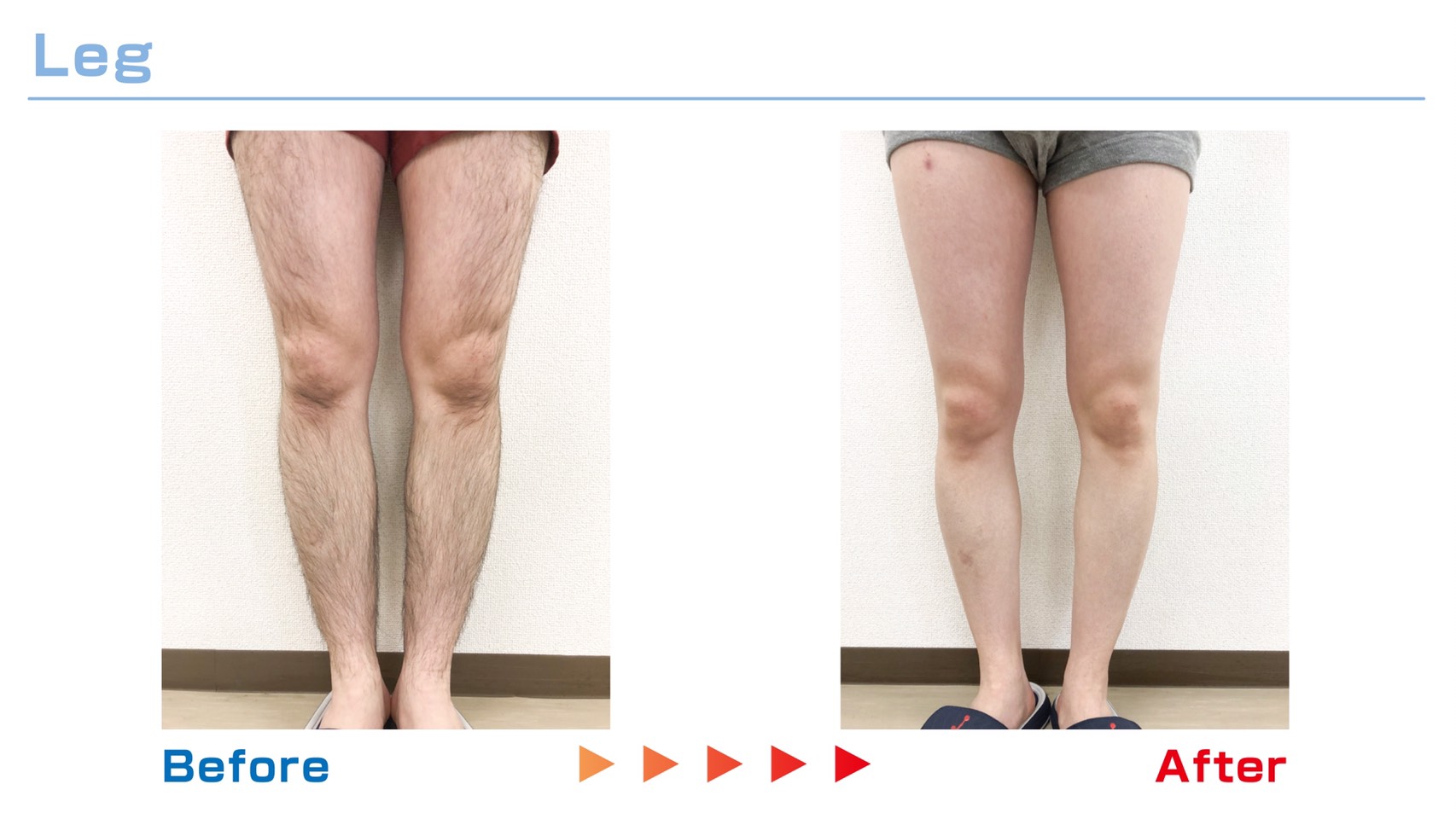脚の脱毛 Before / After