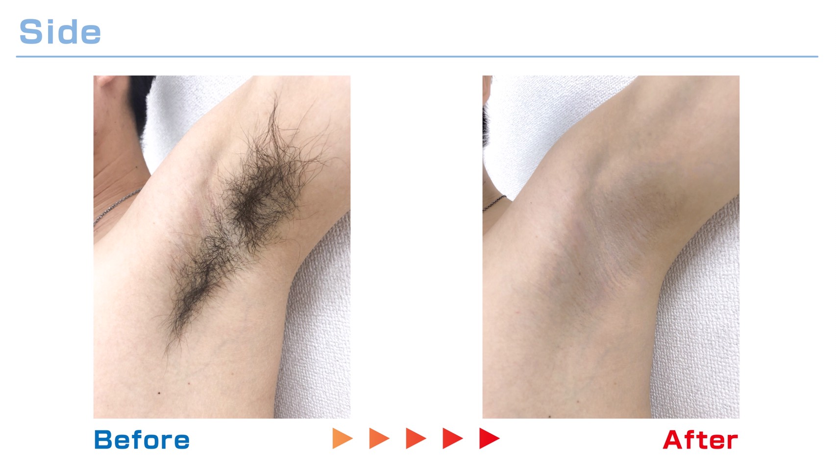 脇の脱毛 Before / After